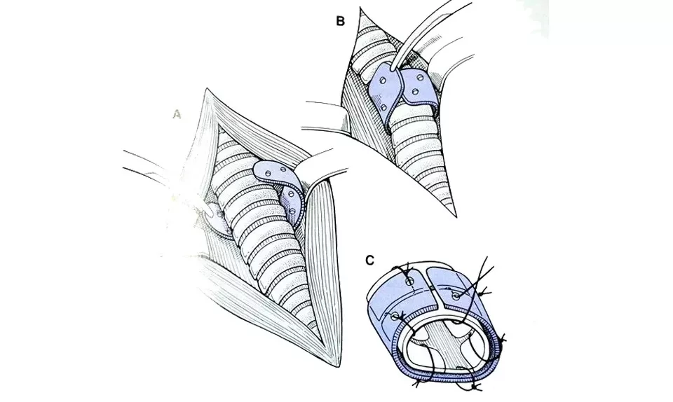 For severe cases, procedures such as tracheal stent placement or tracheoplasty can help restore the normal structure of the trachea.
